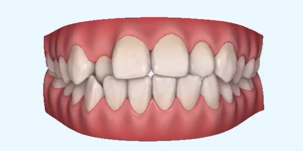 crossbite