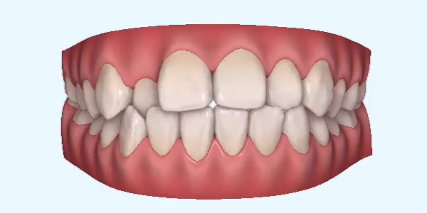 crossbite