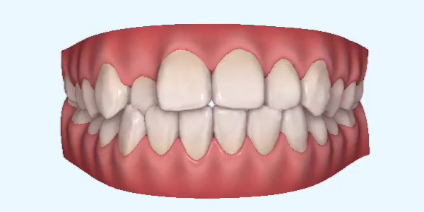 crossbite