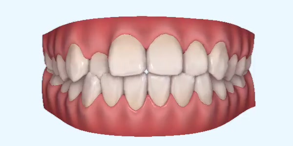 crossbite